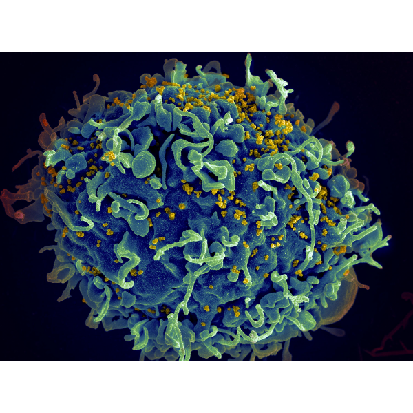 New Highly Virulent And Damaging HIV Variant Discovered In The ...